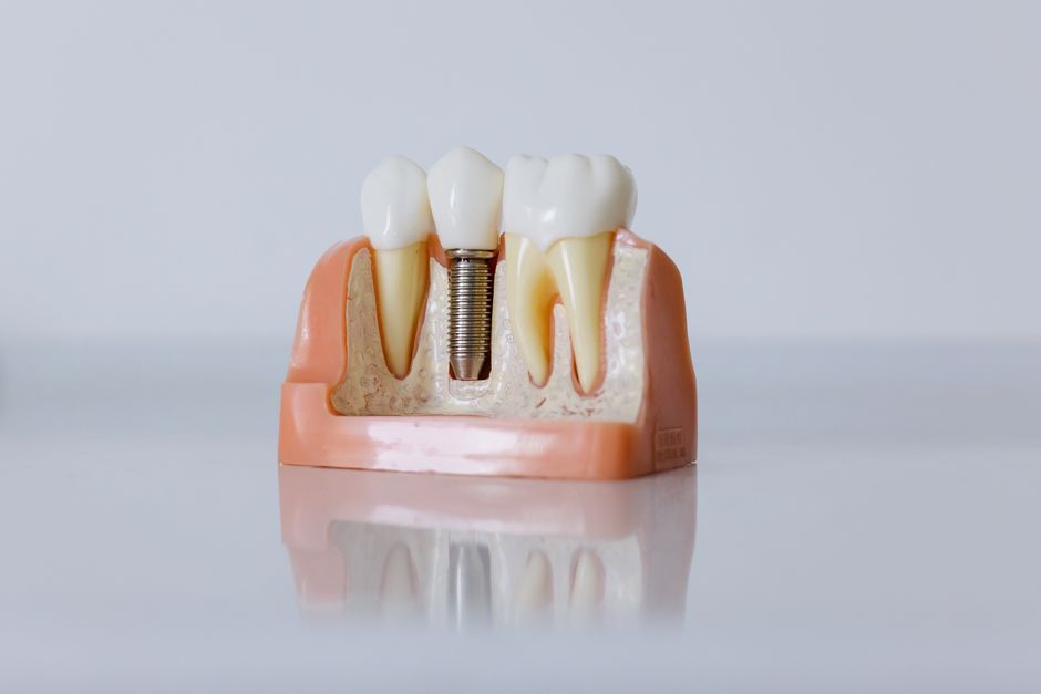 Todo lo que necesitas saber sobre el precio de los implantes dentales